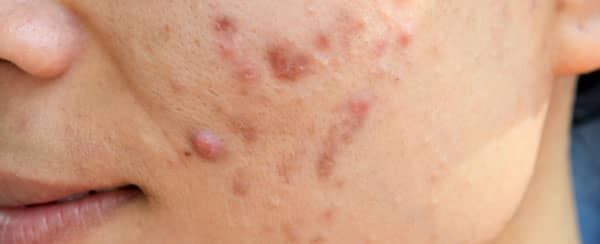 Accutane and ibd lawsuit