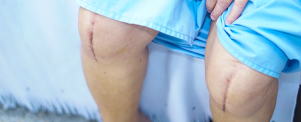 Knee Replacement Lawsuits